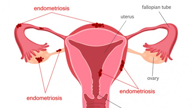 Best Surgical treatment for endometriosis in India